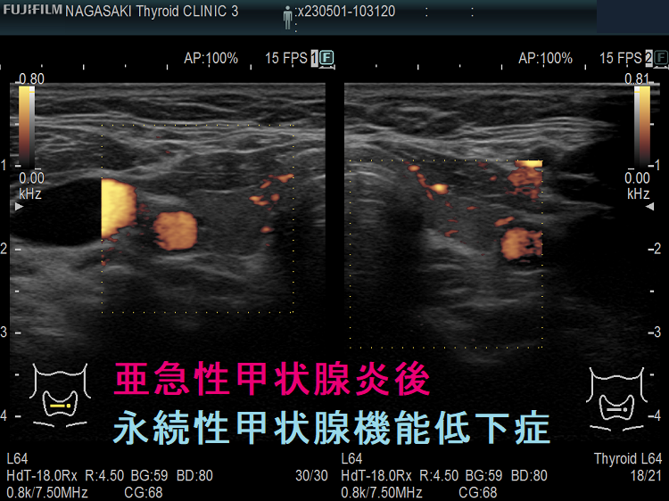 亜急性甲状腺炎後永続性甲状腺機能低下症 超音波(エコー)画像 ドプラーモード 亜急性甲状腺炎後永続性甲状腺機能低下症 超音波(エコー)画像 ドプラーモード