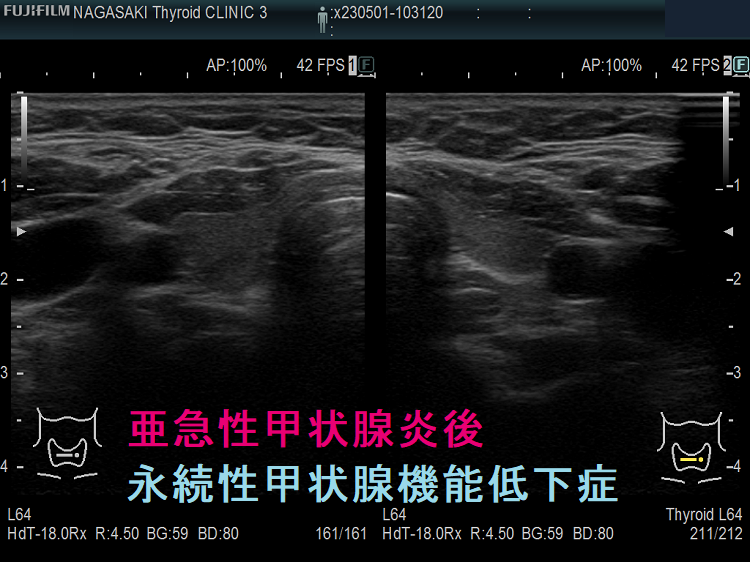 亜急性甲状腺炎後永続性甲状腺機能低下症 超音波(エコー)画像 亜急性甲状腺炎後永続性甲状腺機能低下症 超音波(エコー)画像