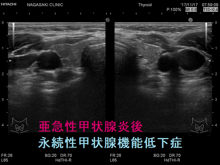 亜急性甲状腺炎後永続性甲状腺機能低下症 亜急性甲状腺炎後永続性甲状腺機能低下症