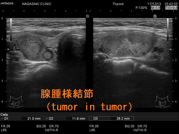 腺腫様結節(tumor in tumor) 腺腫様結節(tumor in tumor)