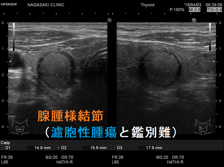 腺腫様結節(濾胞性腫瘍と鑑別難)超音波(エコー)画像 腺腫様結節(濾胞性腫瘍と鑑別難)超音波(エコー)画像