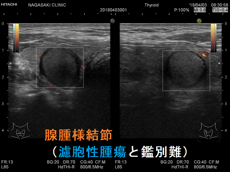 腺腫様結節(濾胞性腫瘍と鑑別難)ドプラー 腺腫様結節(濾胞性腫瘍と鑑別難)ドプラー