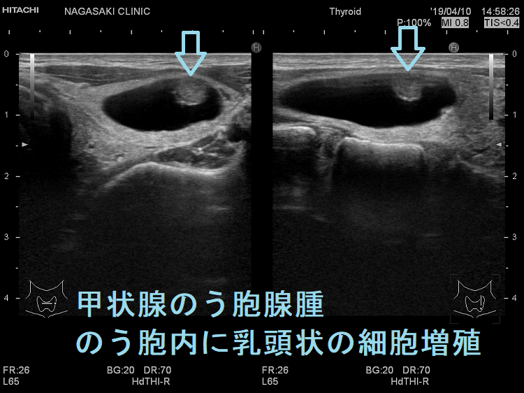 甲状腺のう胞腺腫 のう胞内に乳頭状の細胞増殖 超音波(エコー)画像 甲状腺のう胞腺腫 のう胞内に乳頭状の細胞増殖 超音波(エコー)画像