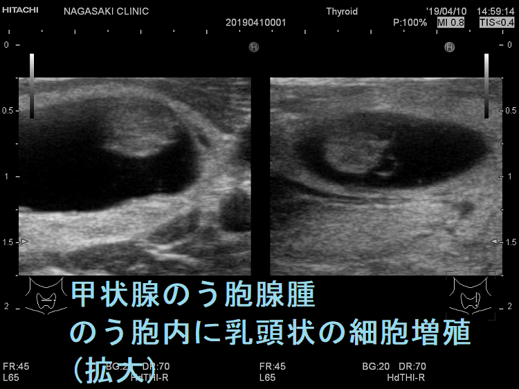 甲状腺のう胞腺腫 のう胞内に乳頭状の細胞増殖 超音波(エコー)画像(拡大) 甲状腺のう胞腺腫 のう胞内に乳頭状の細胞増殖 超音波(エコー)画像(拡大)