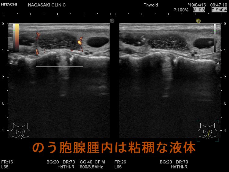 のう胞腺腫内は粘調な液体 のう胞腺腫内は粘調な液体