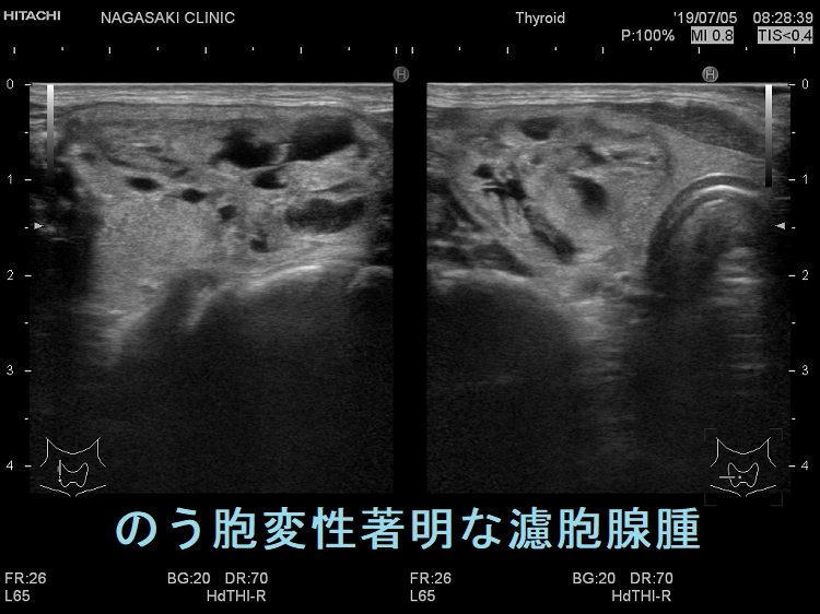 のう胞変性著明な濾胞腺腫 超音波(エコー)画像 のう胞変性著明な濾胞腺腫 超音波(エコー)画像