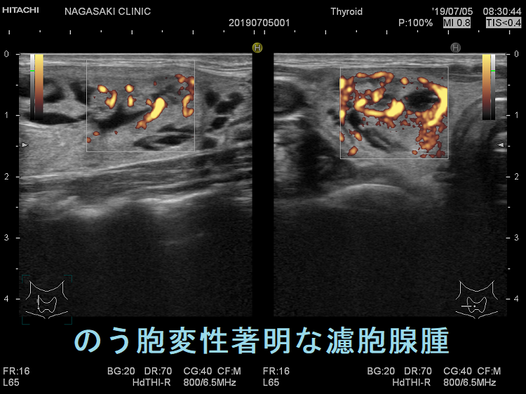 のう胞変性著明な濾胞腺腫 超音波(エコー)画像 ドプラーモード のう胞変性著明な濾胞腺腫 超音波(エコー)画像 ドプラーモード