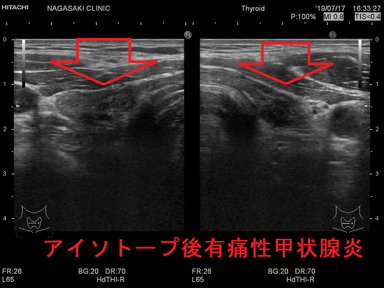 アイソトープ後有痛性甲状腺炎 超音波(エコー)画像 アイソトープ後有痛性甲状腺炎 超音波(エコー)画像