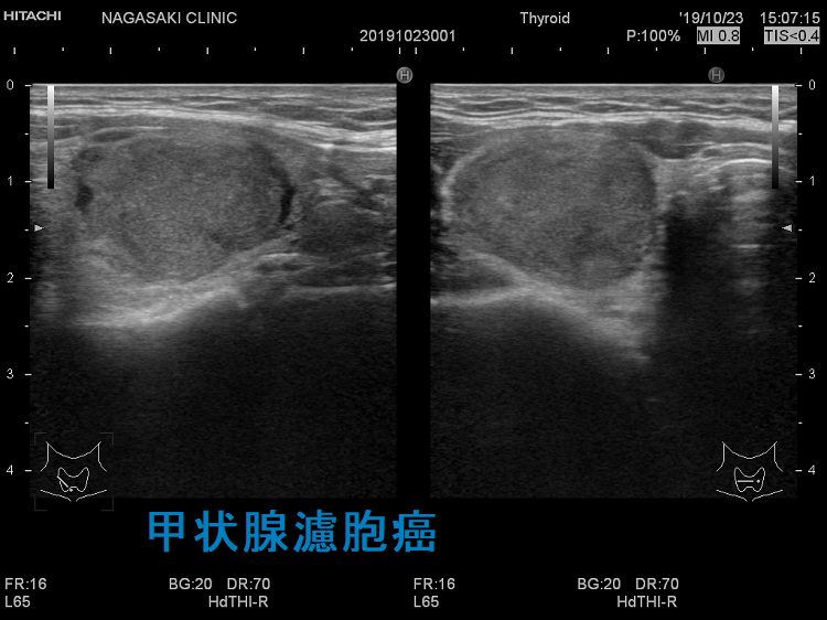 甲状腺濾胞癌 甲状腺濾胞癌