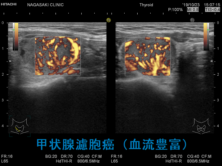 甲状腺濾胞癌(血流豊富) 甲状腺濾胞癌(血流豊富)
