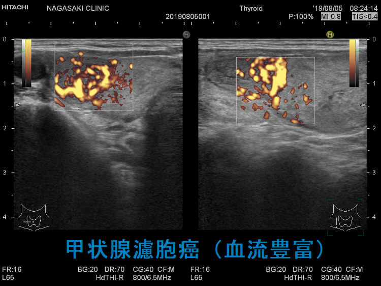 甲状腺濾胞癌(血流豊富)超音波エコー画像 甲状腺濾胞癌(血流豊富)超音波エコー画像