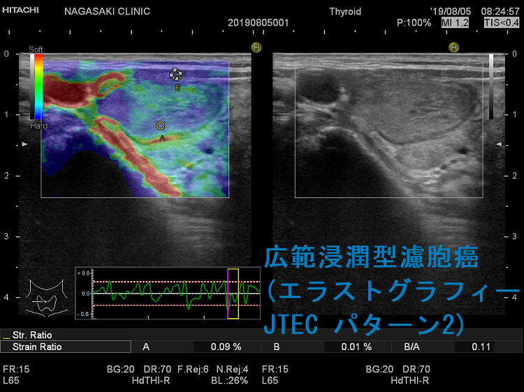 広範浸潤型濾胞癌 (エラストグラフィー JTEC パターン2) 広範浸潤型濾胞癌 (エラストグラフィー JTEC パターン2)