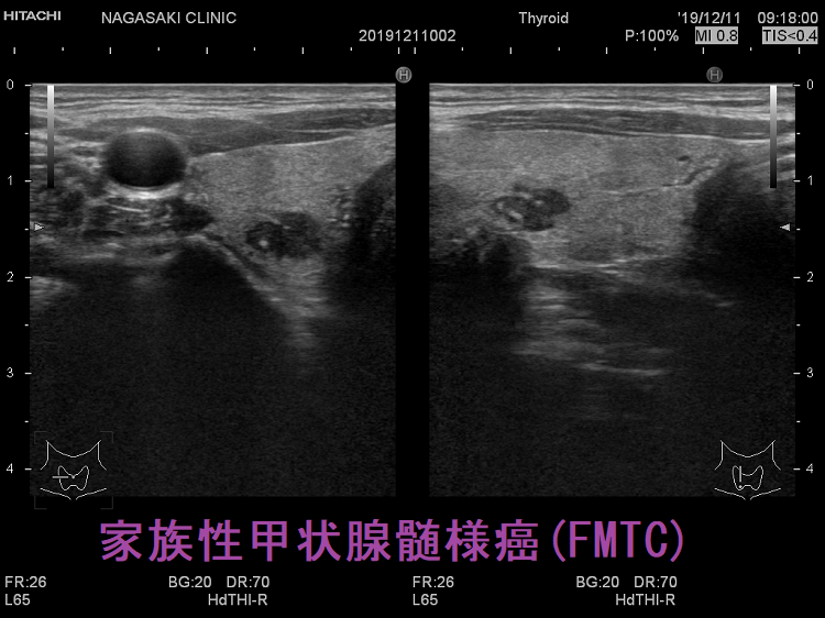 家族性甲状腺髄様癌 超音波(エコー)画像 家族性甲状腺髄様癌 超音波(エコー)画像