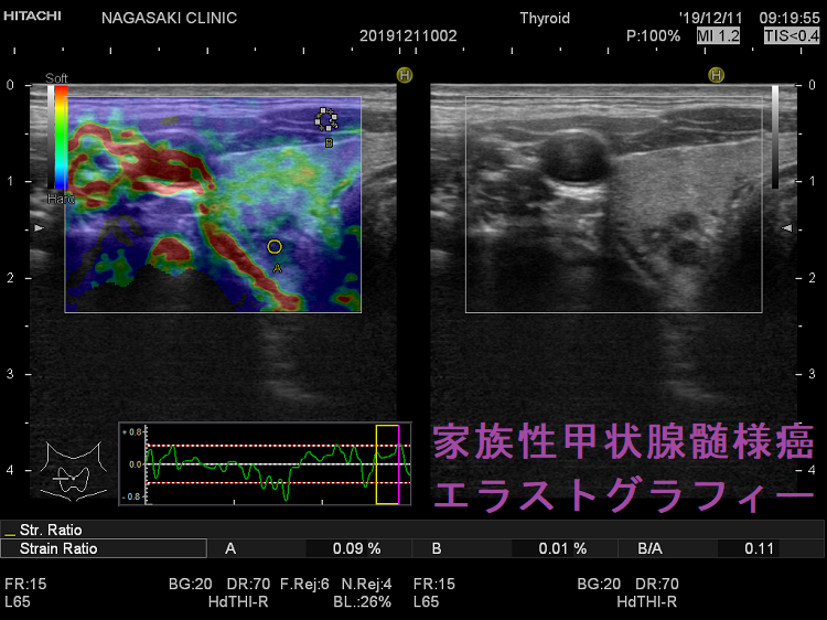 家族性甲状腺髄様癌 エラストグラフィー 家族性甲状腺髄様癌 エラストグラフィー