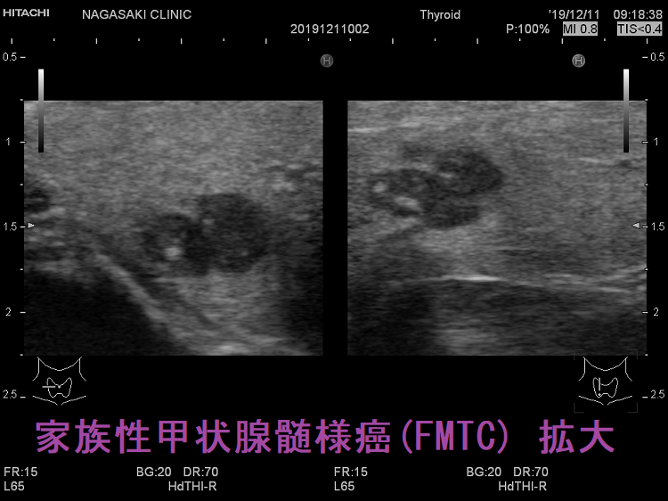 家族性甲状腺髄様癌 超音波(エコー)画像 拡大 家族性甲状腺髄様癌 超音波(エコー)画像 拡大