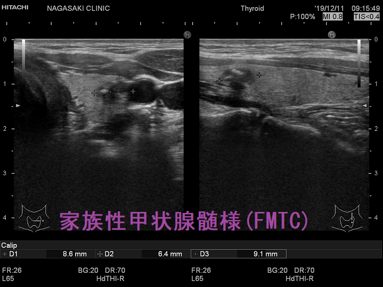 家族性甲状腺髄様癌(FMTC) 超音波(エコー)画像 家族性甲状腺髄様癌(FMTC) 超音波(エコー)画像