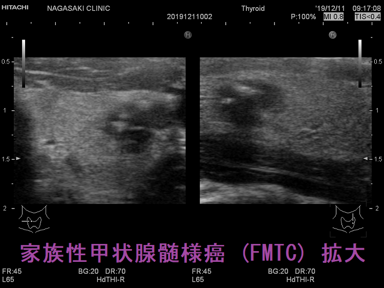 家族性甲状腺髄様癌(FMTC) 超音波(エコー)画像 拡大 家族性甲状腺髄様癌(FMTC) 超音波(エコー)画像 拡大