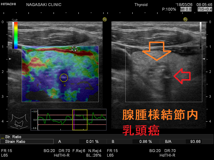 腺腫様結節内乳頭癌 超音波(エコー)画像 腺腫様結節内乳頭癌 超音波(エコー)画像