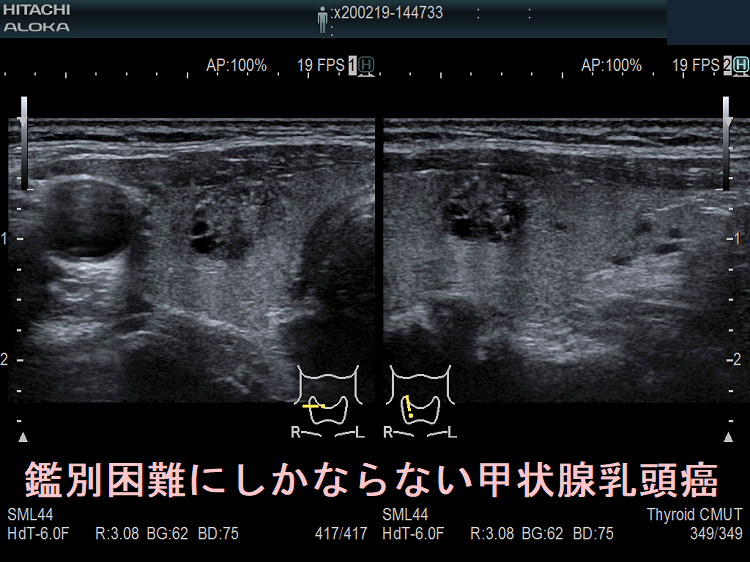 鑑別困難にしかならない甲状腺乳頭癌 超音波(エコー)画像 鑑別困難にしかならない甲状腺乳頭癌 超音波(エコー)画像