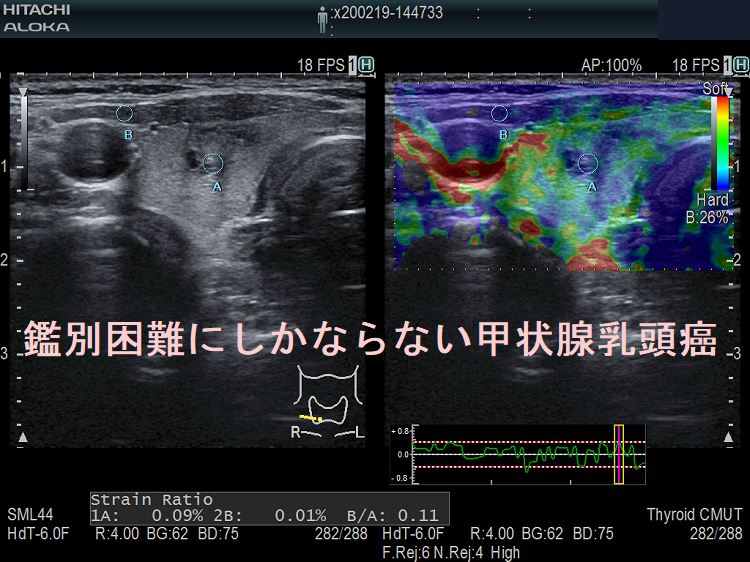 鑑別困難にしかならない甲状腺乳頭癌 エラストグラフィー 鑑別困難にしかならない甲状腺乳頭癌 エラストグラフィー