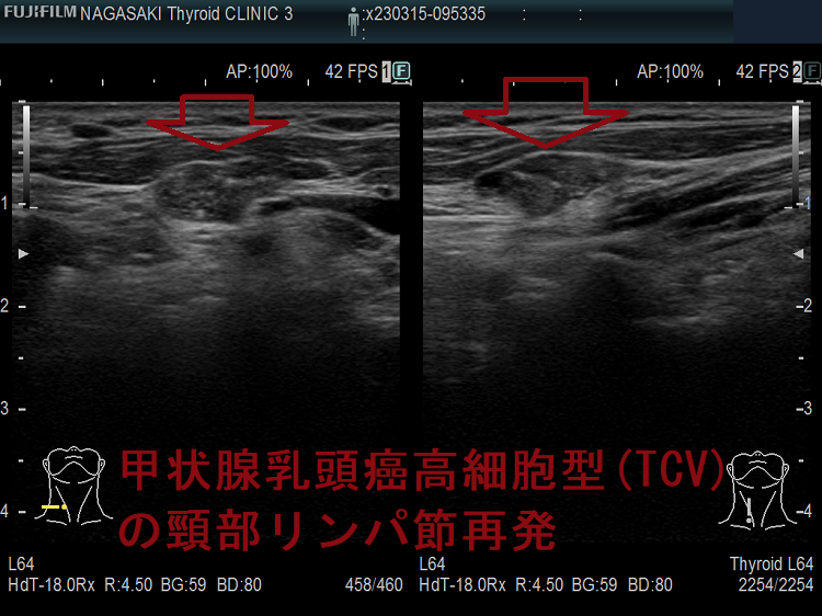 甲状腺乳頭癌高細胞型(TCV)の頸部リンパ節再発 甲状腺乳頭癌高細胞型(TCV)の頸部リンパ節再発