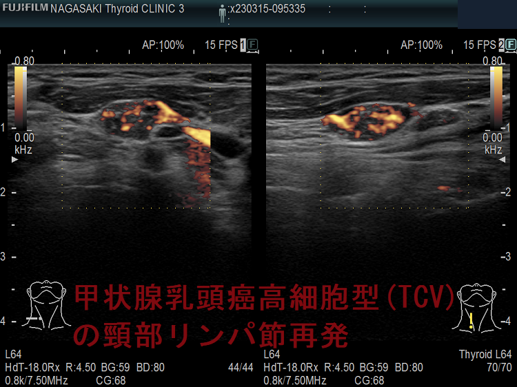 高悪性度(高増殖型,高MIB-1標識率)甲状腺乳頭癌高細胞型