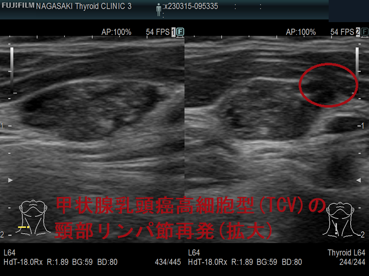 甲状腺乳頭癌高細胞型(TCV)の頸部リンパ節再発(拡大) 甲状腺乳頭癌高細胞型(TCV)の頸部リンパ節再発(拡大)