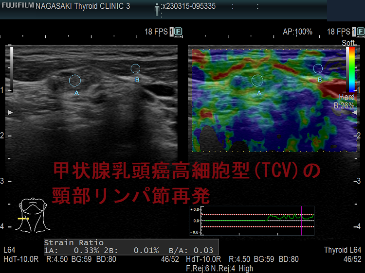 甲状腺乳頭癌高細胞型(TCV)の頸部リンパ節再発 エラストグラフィー 甲状腺乳頭癌高細胞型(TCV)の頸部リンパ節再発 エラストグラフィー