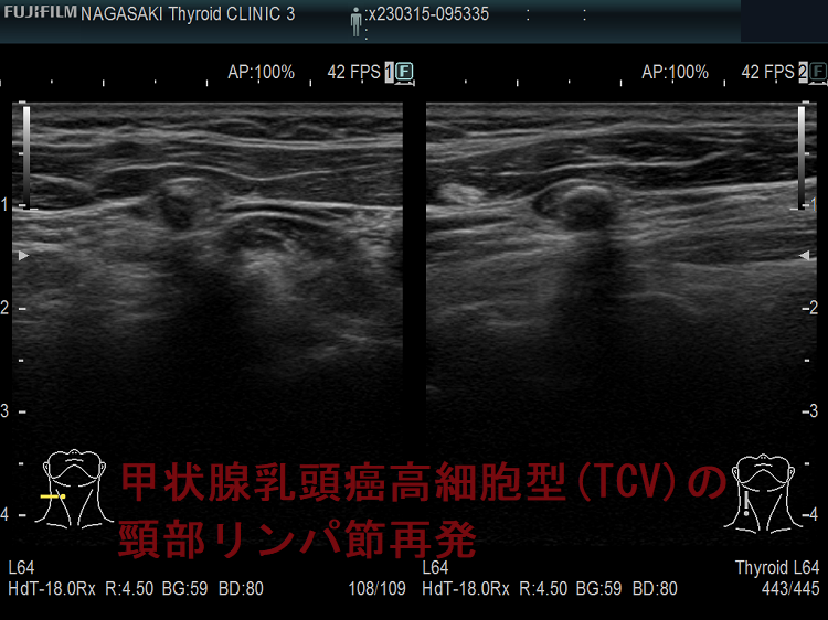 甲状腺乳頭癌高細胞型(TCV)の頸部リンパ節再発2 甲状腺乳頭癌高細胞型(TCV)の頸部リンパ節再発2