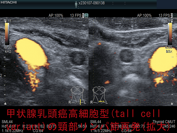 高悪性度(高増殖型,高MIB-1標識率)甲状腺乳頭癌高細胞型