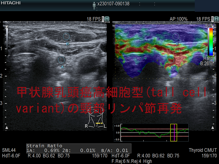 甲状腺乳頭癌高細胞型(tall cell variant)の頸部リンパ節再発 エラストグラフィー 甲状腺乳頭癌高細胞型(tall cell variant)の頸部リンパ節再発 エラストグラフィー