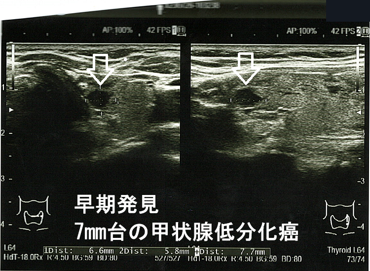 早期発見 7mm台の甲状腺低分化癌 早期発見 7mm台の甲状腺低分化癌