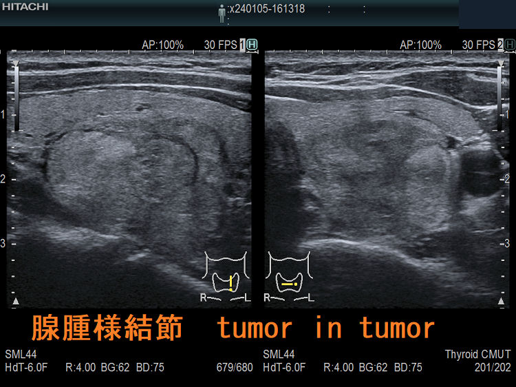 腺腫様結節 tumor in tumor 腺腫様結節 tumor in tumor
