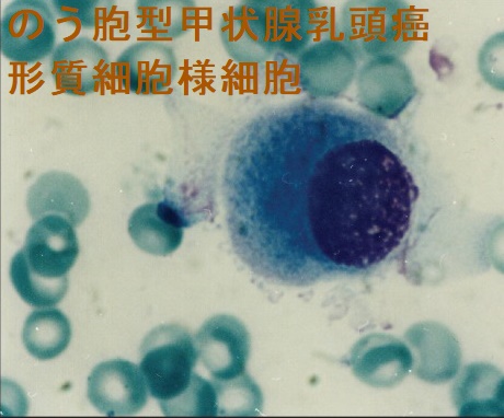 のう胞型甲状腺乳頭癌 形質細胞様細胞 のう胞型甲状腺乳頭癌 形質細胞様細胞