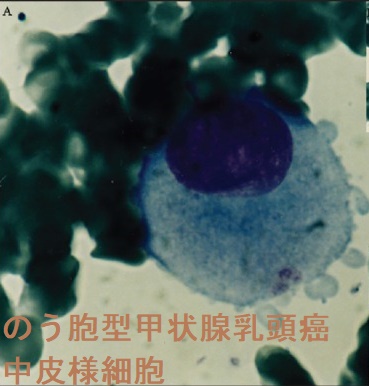 のう胞型甲状腺乳頭癌 中皮様細胞 のう胞型甲状腺乳頭癌 中皮様細胞