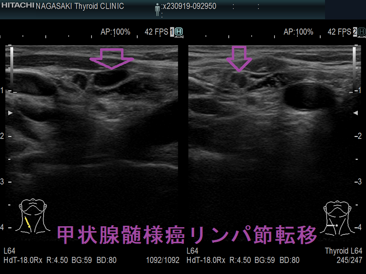 甲状腺髄様癌リンパ節転移 甲状腺髄様癌リンパ節転移