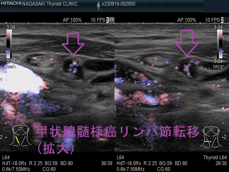 甲状腺髄様癌リンパ節転移(拡大)ドプラーモード 甲状腺髄様癌リンパ節転移(拡大)ドプラーモード