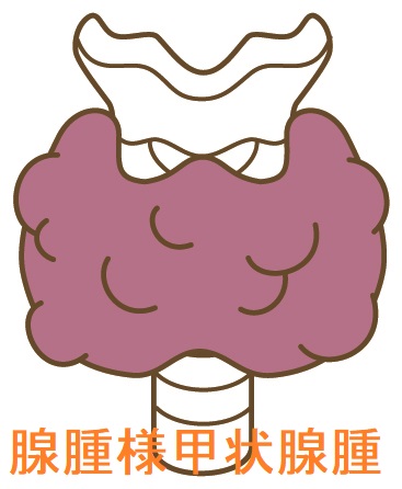 腺腫様甲状腺腫 腺腫様甲状腺腫