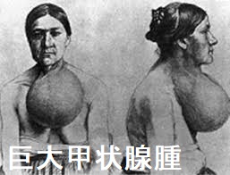 巨大甲状腺腫 巨大甲状腺腫