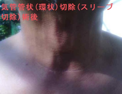甲状腺乳頭癌 気管浸潤 気管管状(環状)切除(スリーブ切除)術後 甲状腺乳頭癌 気管浸潤 気管管状(環状)切除(スリーブ切除)術後