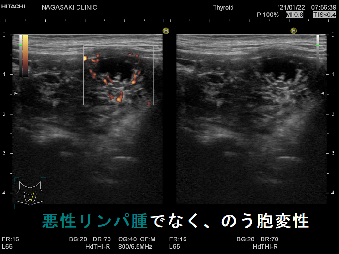 悪性リンパ腫でなく、のう胞変性 悪性リンパ腫でなく、のう胞変性