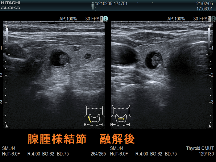 腺腫様結節 融解後 腺腫様結節 融解後