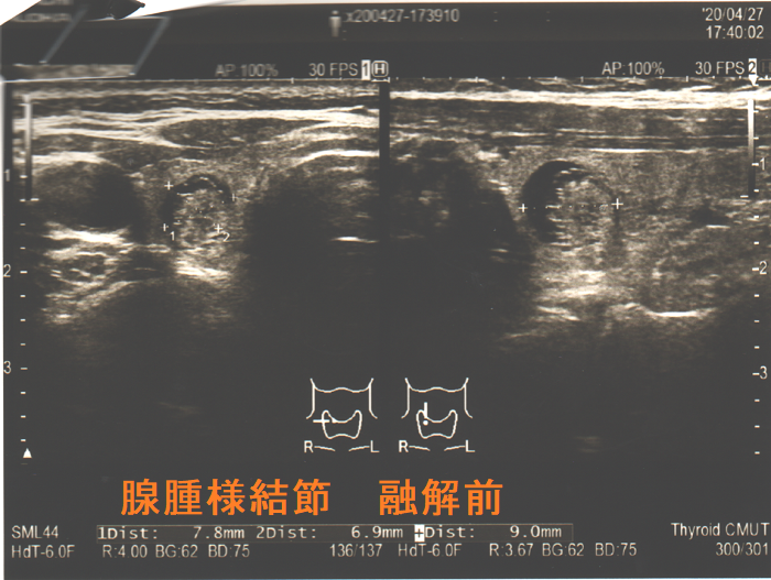 腺腫様結節 融解前 腺腫様結節 融解前