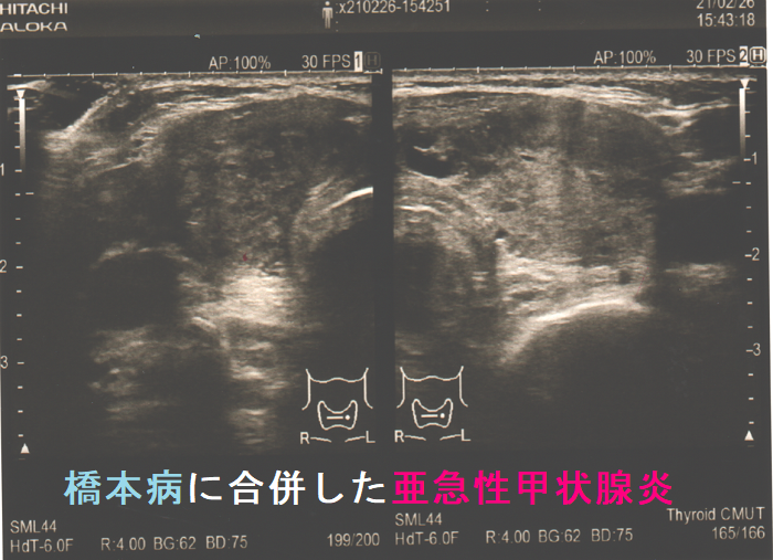 橋本病に合併した亜急性甲状腺炎 超音波(エコー)画像 橋本病に合併した亜急性甲状腺炎 超音波(エコー)画像