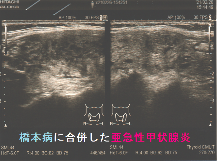 橋本病に合併した亜急性甲状腺炎 超音波(エコー)画像 橋本病に合併した亜急性甲状腺炎 超音波(エコー)画像