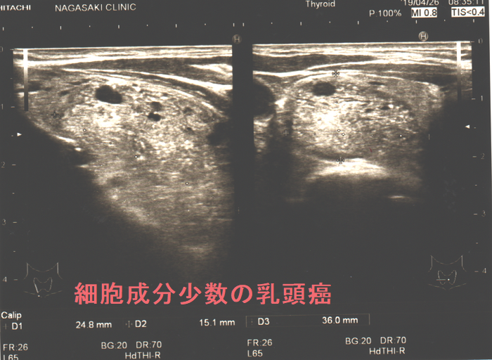 細胞成分少数で判定できない甲状腺乳頭癌 細胞成分少数で判定できない甲状腺乳頭癌