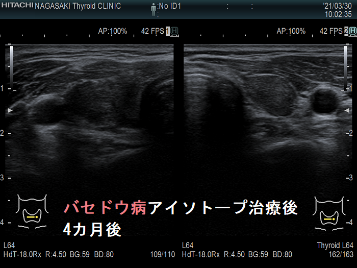 アイソトープ(放射性ヨウ素; 131-I)治療4カ月後 アイソトープ(放射性ヨウ素; 131-I)治療4カ月後