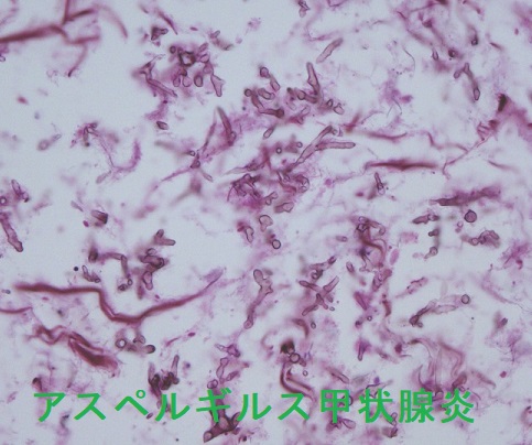 アスペルギルス甲状腺炎 組織像 アスペルギルス甲状腺炎 組織像