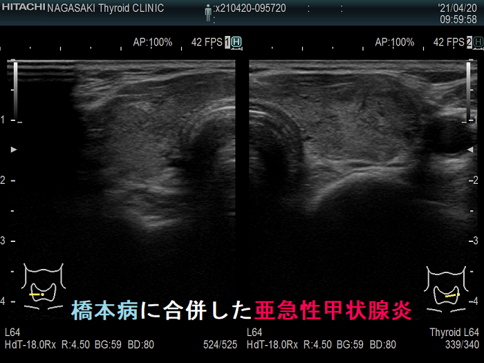 橋本病に合併した亜急性甲状腺炎 2カ月後 超音波(エコー)画像 橋本病に合併した亜急性甲状腺炎 2カ月後 超音波(エコー)画像1