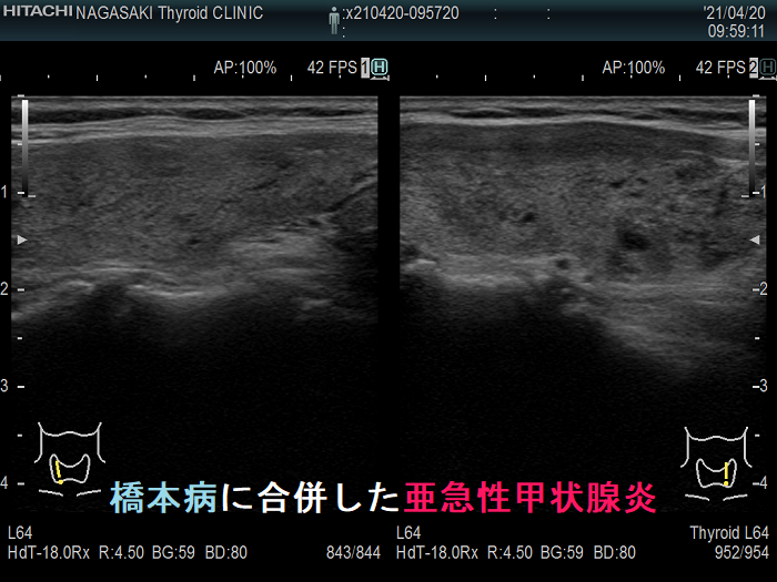 橋本病に合併した亜急性甲状腺炎 2カ月後 超音波(エコー)画像 橋本病に合併した亜急性甲状腺炎 2カ月後 超音波(エコー)画像2